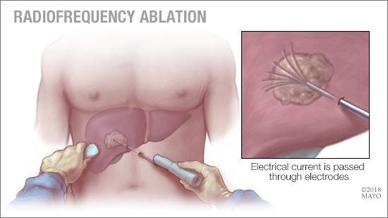 a-medical-illustration-of-radiofrequency-ablation-original علاج آلام الأورام السرطانية: التقنيات الحديثة لتحسين جودة الحياة