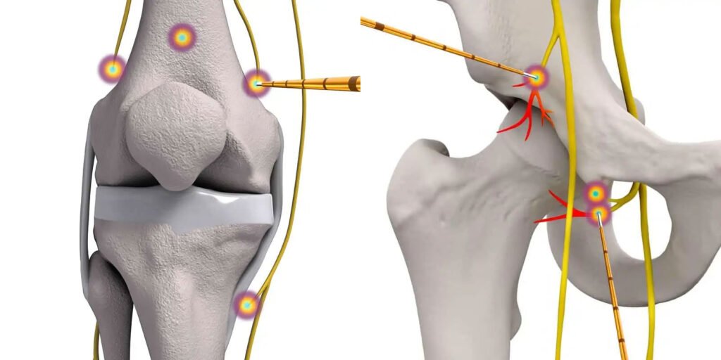 radiofrequency-ablation-1-1024x512 علاج آلام المفاصل التنكسية/بتقنيات طب الالم